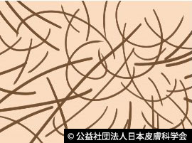 男性型脱毛症患者