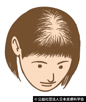 女性型脱毛症
