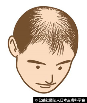 男性型脱毛症
