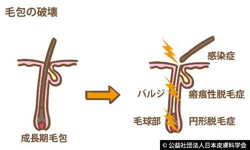 毛包の破壊