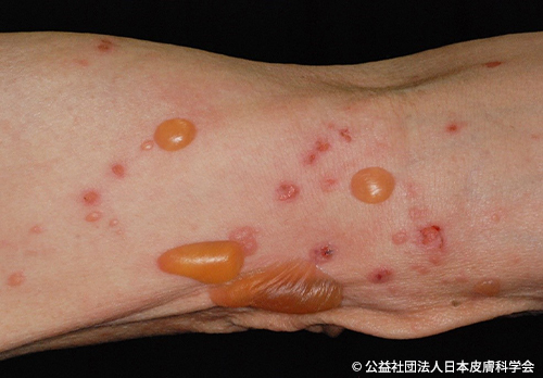 資料1 水疱性類天疱瘡の皮膚病変