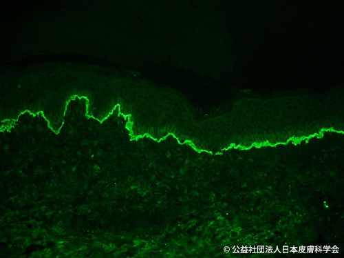 資料3 水疱性類天疱瘡における蛍光抗体直接法陽性所見