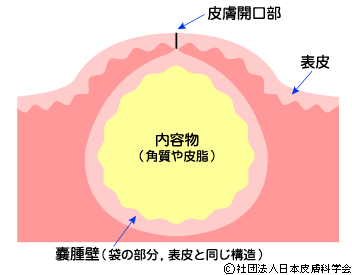 耳たぶや股に痛い出来物ができたらそれは感染症粉瘤かもしれません