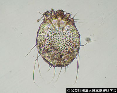 虫 マダニ類 による予期せぬ感染症 Q1 皮膚科q A 公益社団法人日本皮膚科学会