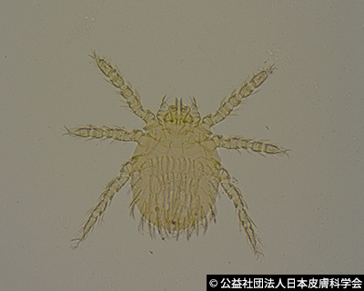 虫 マダニ類 による予期せぬ感染症 Q6 皮膚科q A 公益社団法人日本皮膚科学会