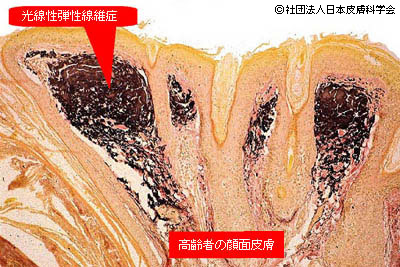 光線性弾性線維症
