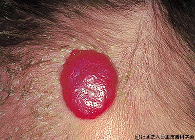 資料18:イチゴ状血管腫