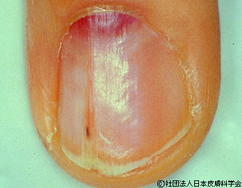 資料22:グロムス腫瘍