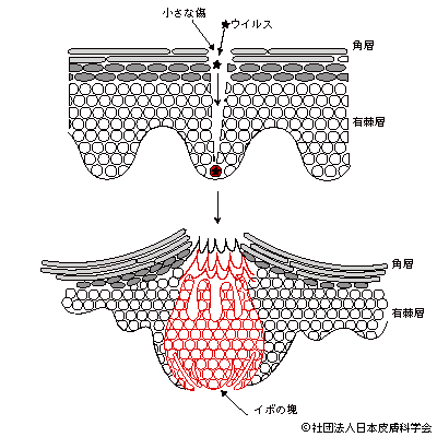 イボとミズイボ ウオノメとタコ どう違うのですか Q2 皮膚科q A 公益社団法人日本皮膚科学会