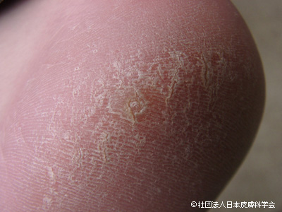 多汗症で荒れた踵部にできたイボ。