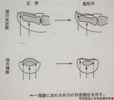 爪甲側縁を短く切ったために起きたスプーンネイル