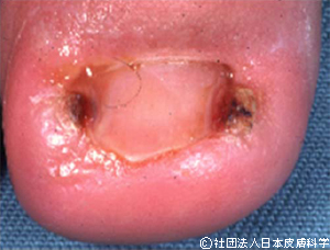 爪甲側縁は埋没し、爪郭部は腫脹。