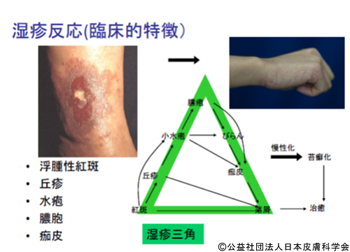湿疹反応（臨床的特徴）
