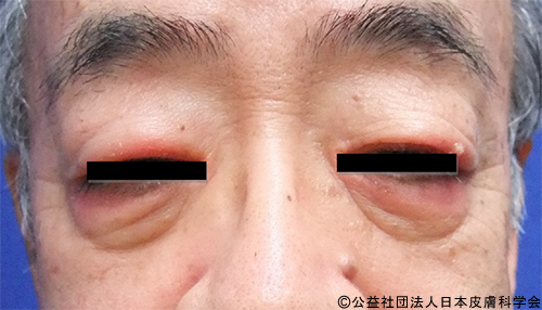 点眼薬による接触皮膚炎