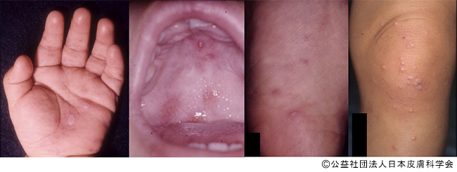子供のウィルス感染症 Q14 皮膚科q A 公益社団法人日本皮膚科学会