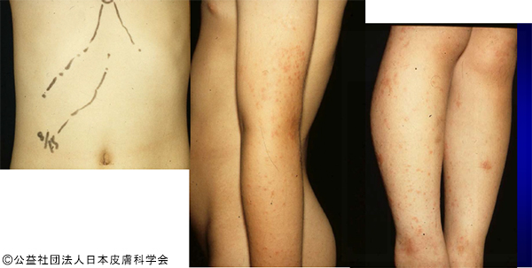 肝臓の腫大、四肢に丘疹・紅斑が出現します 現在ではまれになりました