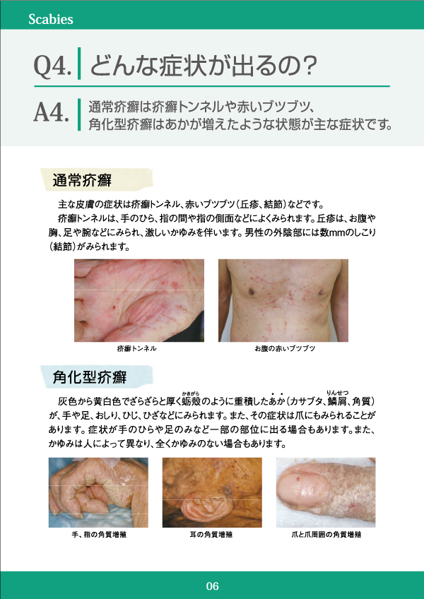 疥癬 かいせん Q4 皮膚科q A 公益社団法人日本皮膚科学会